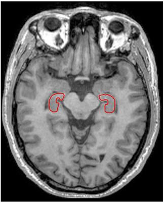 Anisotropy of Anomalous Diffusion Improves the Accuracy of Differentiating and Grading Alzheimer's Disease Using Novel Fractional Motion Model